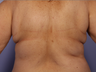 CoolSculpting by Zeltiq to Bra Rolls