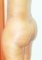 a 29  year old female treated with Brazilian Butt Lift
