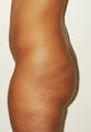 a 29  year old female treated with Brazilian Butt Lift
