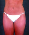 Liposuction of the Hips, Thighs, and Abdomen