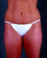Liposuction of the Hips, Thighs, and Abdomen
