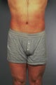 Liposuction