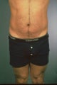 Liposuction