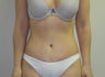 Tummy Tuck
