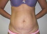 Tummy Tuck