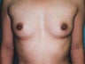 32-Year-Old Female Breast Augmentation
