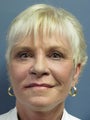 Brow Lift on 60-year-old