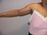 44 year old woman has Arm Lift Surgery