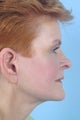 Facelift