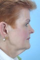 Facelift