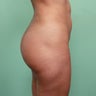 Brazilian Butt Lift