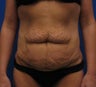 Tummy Tuck