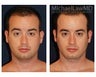 Chin Liposuction - Lower Facial Rejuvenation