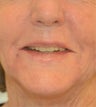 Juvederm