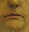 Juvederm