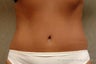 Tummy Tuck Revision  Patient
