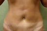 Tummy Tuck Revision  Patient