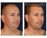 Neck Lift