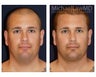 Neck Lift