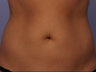CoolSculpting by Zeltiq to Adbomen