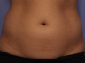 CoolSculpting by Zeltiq to Adbomen