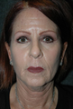 Facelift