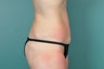 Tummy Tuck