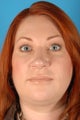 Rhinoplasty