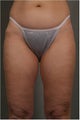 43 year old female would like more contouring in her thighs and waistline