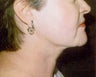Neck Liposuction
