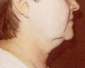 Neck Liposuction