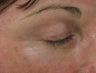 Fraxel re:pair (repair) CO2 laser resurfacing blepharoplasty