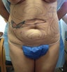 Smart Lipo