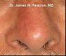Nose Reconstruction / Mohs Reconstruction