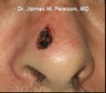 Nose Reconstruction / Mohs Reconstruction