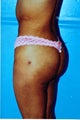Brazilian Butt Lift