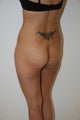Brazilian Butt Lift