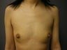 Breast Implants