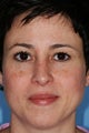 Revision Rhinoplasty