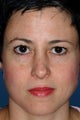 Revision Rhinoplasty