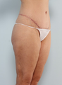 Tummy Tuck - Mommy Makeover 