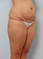Tummy Tuck - Mommy Makeover 