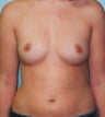 24-Year-Old Female Breast Augmentation