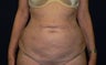 Tummy Tuck