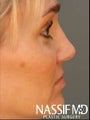 Female Revision Rhinoplasty 