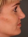 Female Revision Rhinoplasty 