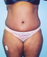 43 year old Female underwent tummy tuck and liposuction to waist and hips