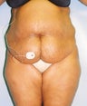 43 year old Female underwent tummy tuck and liposuction to waist and hips