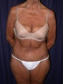 Lipo-Abdominoplasty