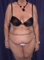 Lipo-Abdominoplasty